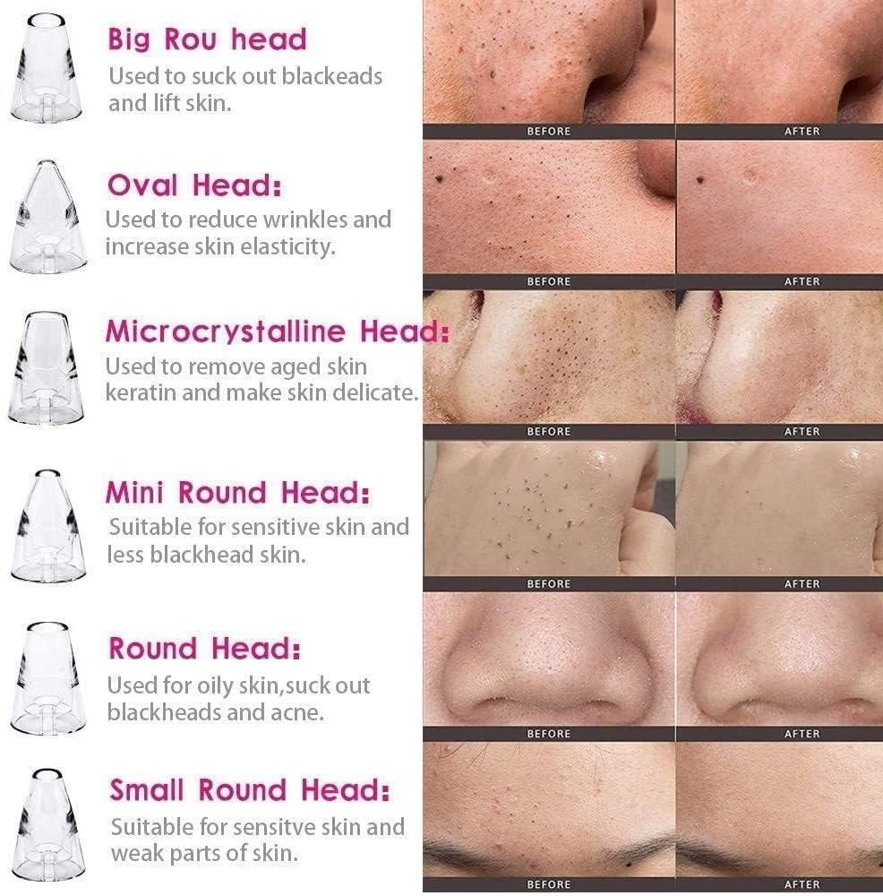 BERN 6 in 1 Multi-function Blackhead Remover Tools